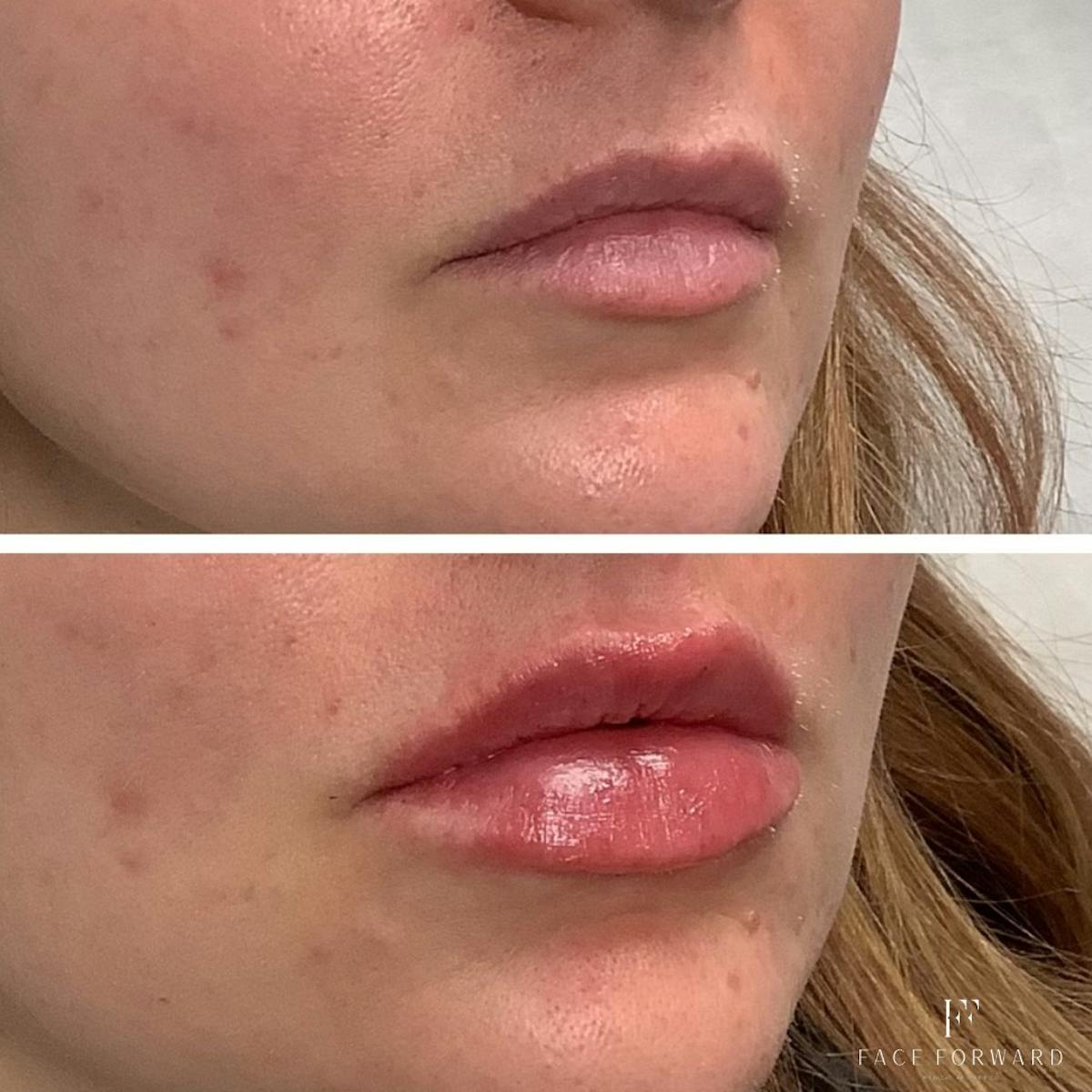 Dermal Filler Before & After Gallery - Patient 100114 - Image 3