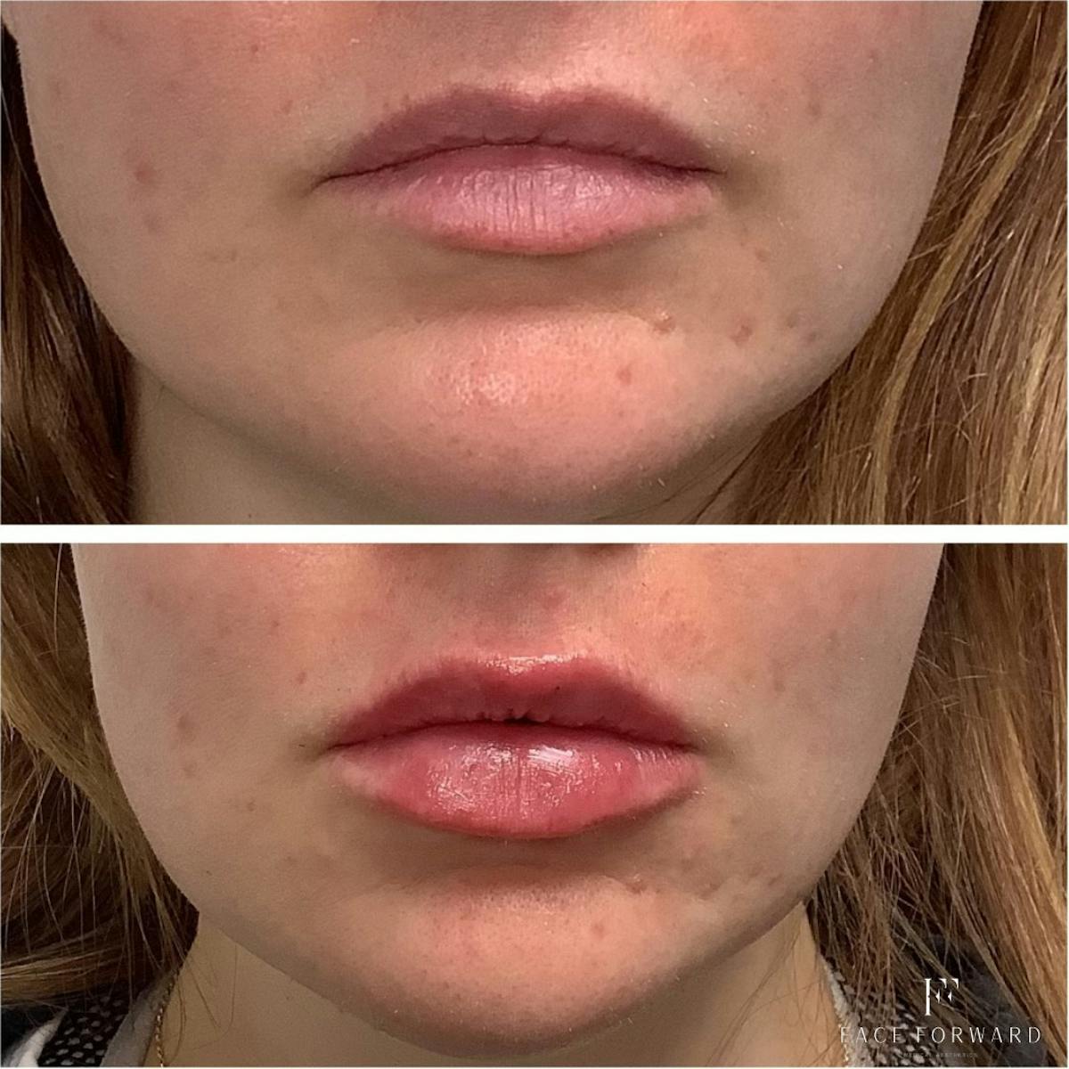 Dermal Filler Before & After Gallery - Patient 100114 - Image 1