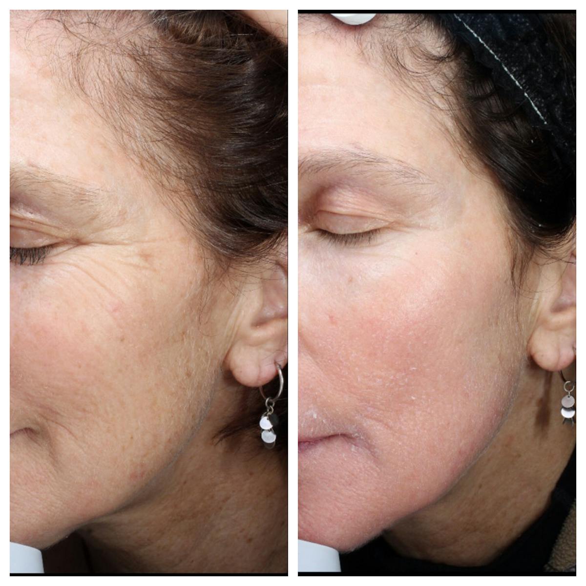 Halo Laser Resurfacing Before & After Gallery - Patient 146866 - Image 1