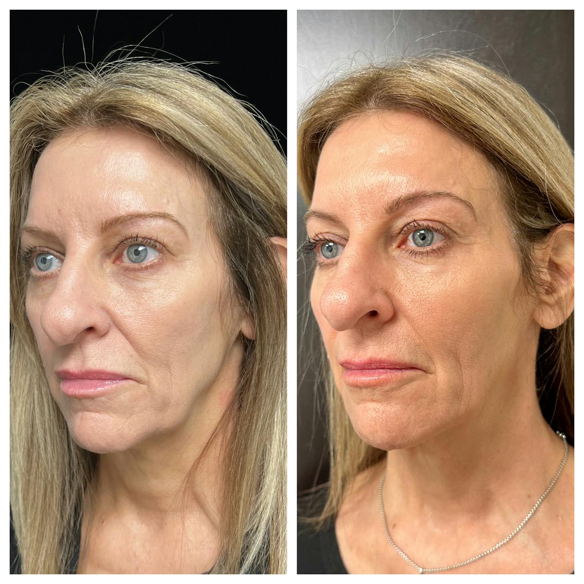 Dermal Filler Before & After Gallery - Patient 329660 - Image 1