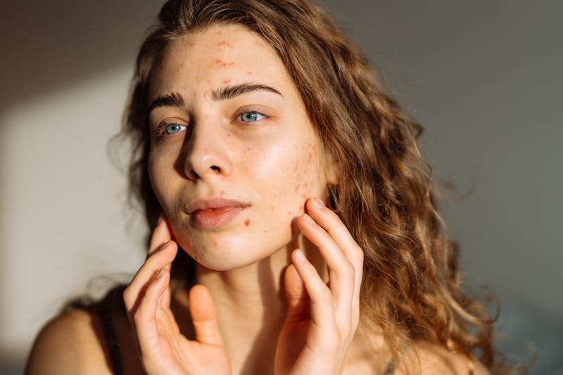 woman with acne touching her face