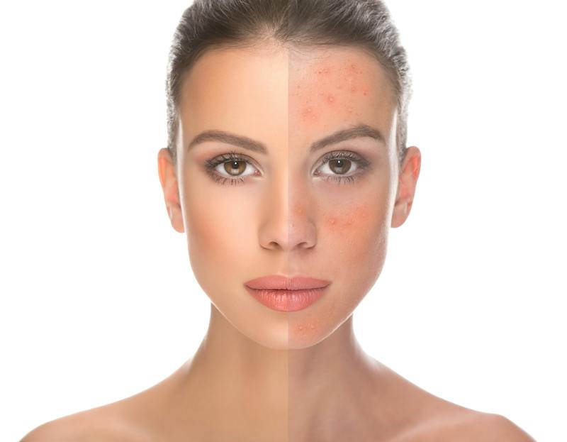 Image of a woman's face, half with redness and the other half flawless