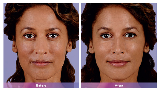 woman before and after juvederm injections