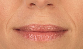 after juvederm injections in lips