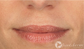 before juvederm injections in lips