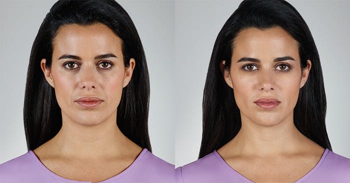 “Juvéderm XC Vollure: A New, Longer Lasting Filler For Smile Lines