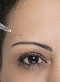 woman getting botox injection above her eyebrow