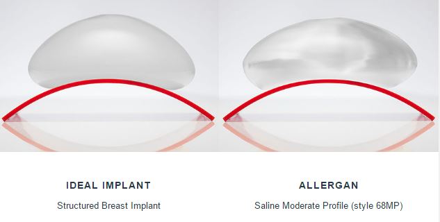 Ideal-AllerganSaline-Implants