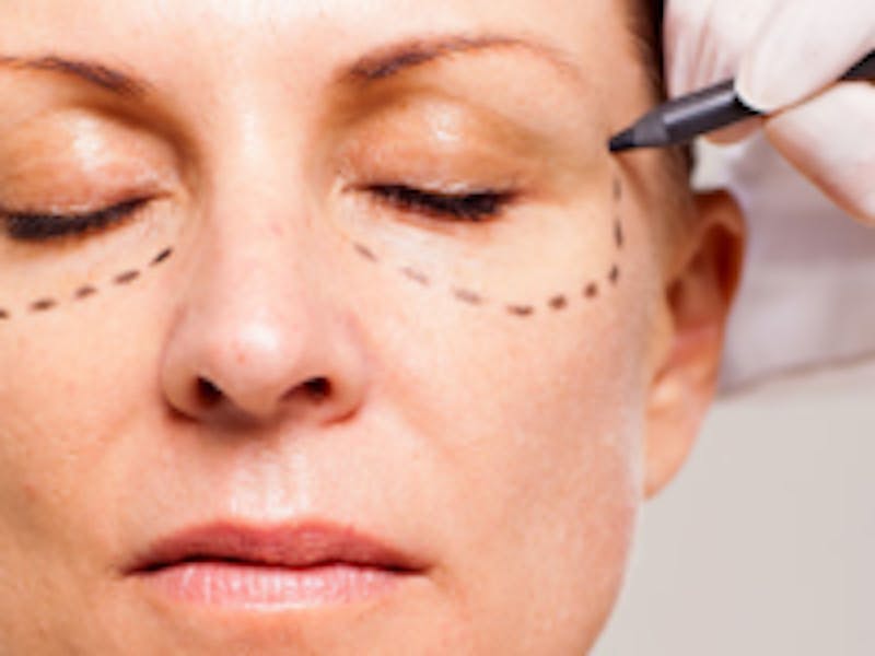 surgeon drawing lines on a woman's face