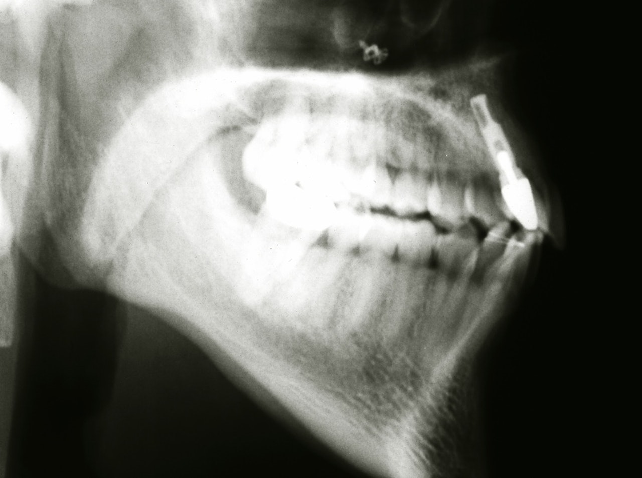 Røntgenbilde av Kristians kjake etter fallet. Røntgenbilde av Kristians kjake etter fallet.