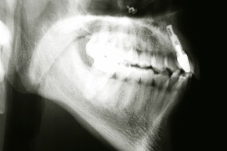 Røntgenbilde av Kristians kjake etter fallet. Røntgenbilde av Kristians kjake etter fallet.