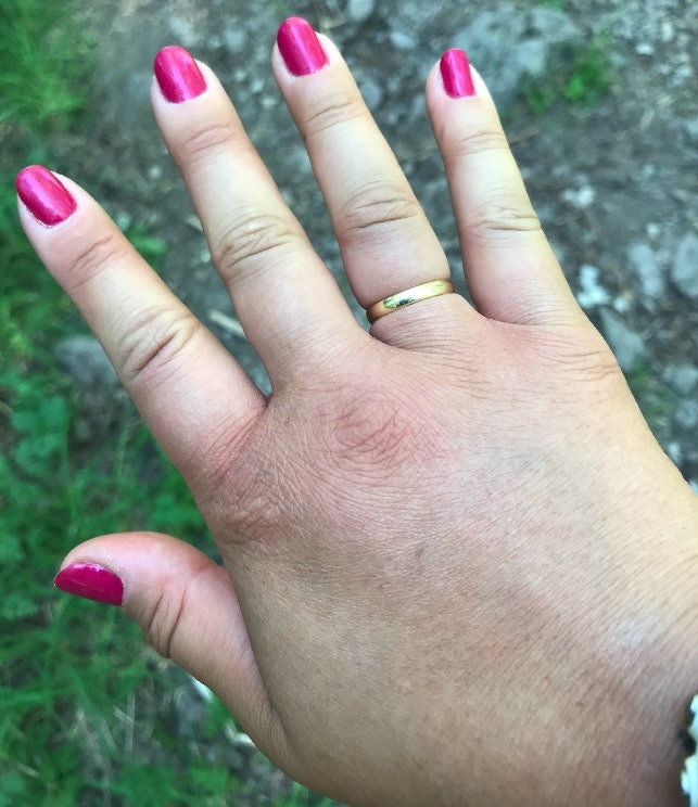 GLEMTE Å TA AV RINGEN: – Jeg prøvde å sitte stille, ha hånda høyt for å få ned blodet og trøkket i armen og jeg fikk av ringen til slutt, forteller Anna. Foto: Privat GLEMTE Å TA AV RINGEN: – Jeg prøvde å sitte stille, ha hånda høyt for å få ned blodet og trøkket i armen og jeg fikk av ringen til slutt, forteller Anna. Foto: Privat