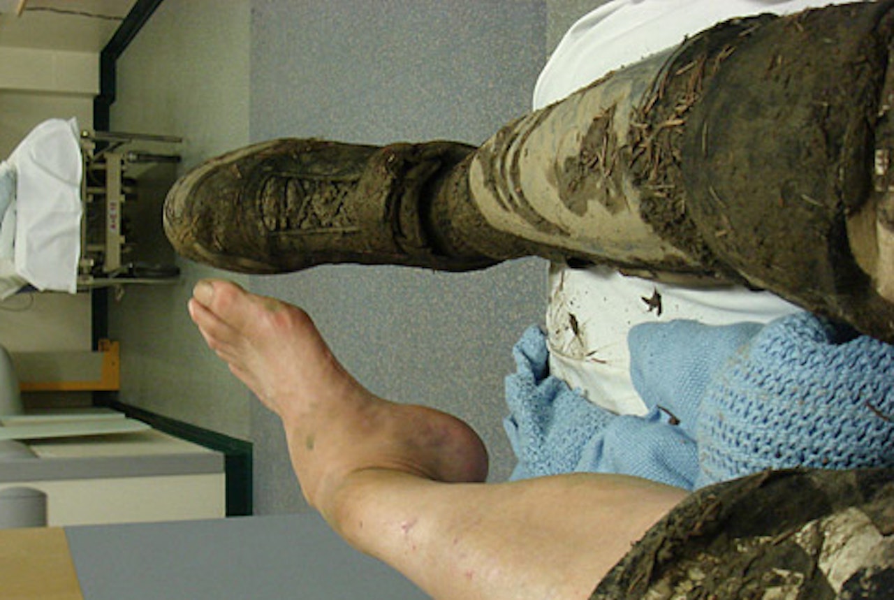 Steve Peats ankel ser alt annet enn bra ut på bildet han selv har tatt i morfinrus på sykehuset. Legen hadde aldri sett en ankel ute av ledd før. Steve frykter nå for VM på hjemmebane i september. Steve Peats ankel ser alt annet enn bra ut på bildet han selv har tatt i morfinrus på sykehuset. Legen hadde aldri sett en ankel ute av ledd før. Steve frykter nå for VM på hjemmebane i september.