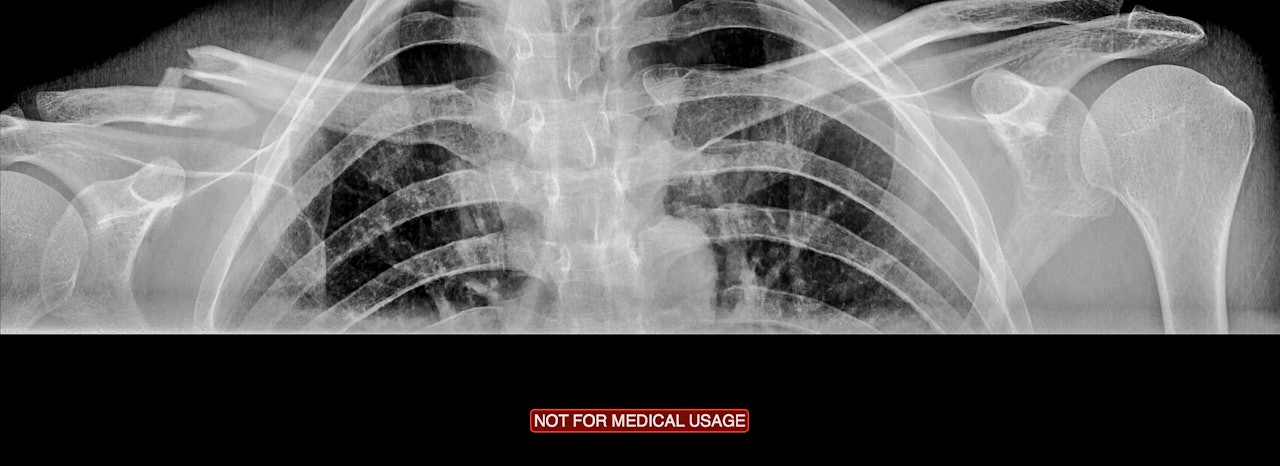 TODELT: Kåres kragebein så slik ut på røngtenbildene. Foto: Røntgenmaskinen på Lillehammer. TODELT: Kåres kragebein så slik ut på røngtenbildene. Foto: Røntgenmaskinen på Lillehammer.