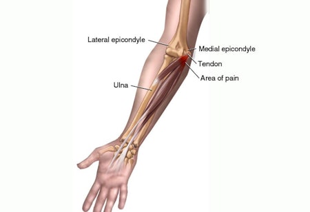 Golfalbue karakteriseres av smerter på innsiden av armen.
