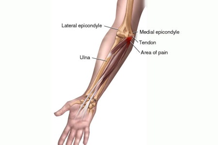 Golfalbue karakteriseres av smerter på innsiden av armen.