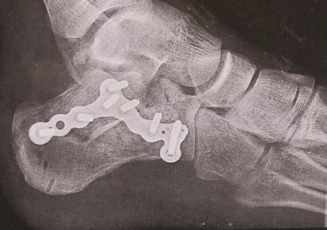 Ankelen til Martin Skaar Olslund etter operasjon. Han falt på led i Yosemite fordi et tak brakk. Foto: Legevakten i Oslo Ankelen til Martin Skaar Olslund etter operasjon. Han falt på led i Yosemite fordi et tak brakk. Foto: Legevakten i Oslo