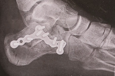 Ankelen til Martin Skaar Olslund etter operasjon. Han falt på led i Yosemite fordi et tak brakk. Foto: Legevakten i Oslo Ankelen til Martin Skaar Olslund etter operasjon. Han falt på led i Yosemite fordi et tak brakk. Foto: Legevakten i Oslo