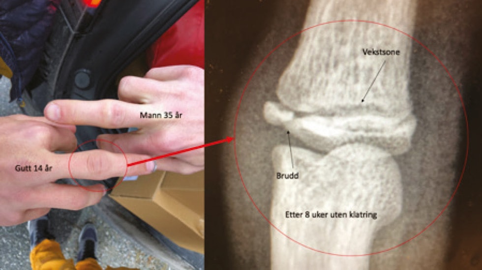 Til høyre ser man et eksempel på et klatrerelatert stressbrudd i vekstplaten (Salter-Harris type 3). Slike brudd tar mange måneder for å gro siden benvevet ligger løst, dette er svært belastende for gira utøvere. Til venstre ser man samme finger (gutt 14) ved siden av en voksen klatrer (35) som hadde samme skade i oppveksten. Fingerskader-beskyttelse-4