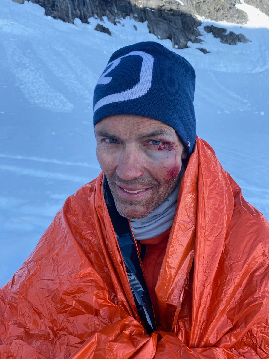 Tore Røysheim fikk seg en skikkelig kavring i krasjen på Slingsbybreen. skade Tore Røysheim topptur