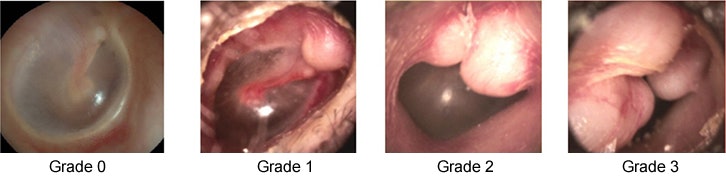 KAN TETTE HELT: Hvis et friskt øre uten noe gjengroing (eksostose) klassifiserer seg til grad 0, er grad 3 en tilstand der benveksten nærmest tetter igjen hele øregangen.