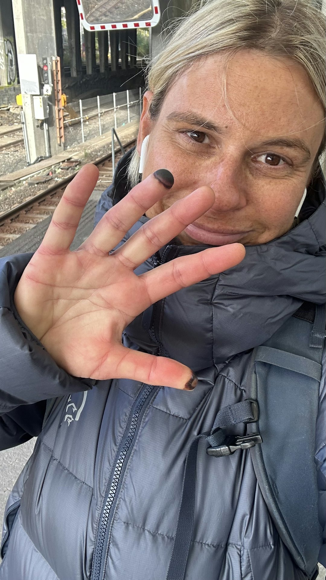 MISTER FINGERTUPP: To av fingertuppene fikk frostskader, men én av dem kommer hun til å miste.. MISTER FINGERTUPP: To av fingertuppene fikk frostskader, men én av dem kommer hun til å miste..