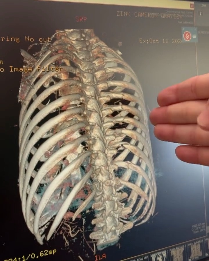 STYGT: Seks ribbeinsbrudd like ved ryggraden. Foto: Privat STYGT: Seks ribbeinsbrudd like ved ryggraden. Foto: Privat