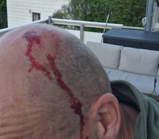 ANGREPET: Elgkua traff blant annet hodet til turgåeren. Foto: privat ANGREPET: Elgkua traff blant annet hodet til turgåeren. Foto: privat