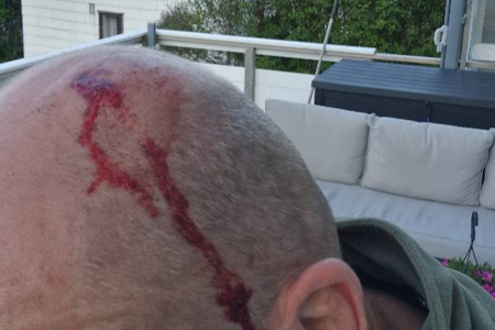 ANGREPET: Elgkua traff blant annet hodet til turgåeren. Foto: privat ANGREPET: Elgkua traff blant annet hodet til turgåeren. Foto: privat