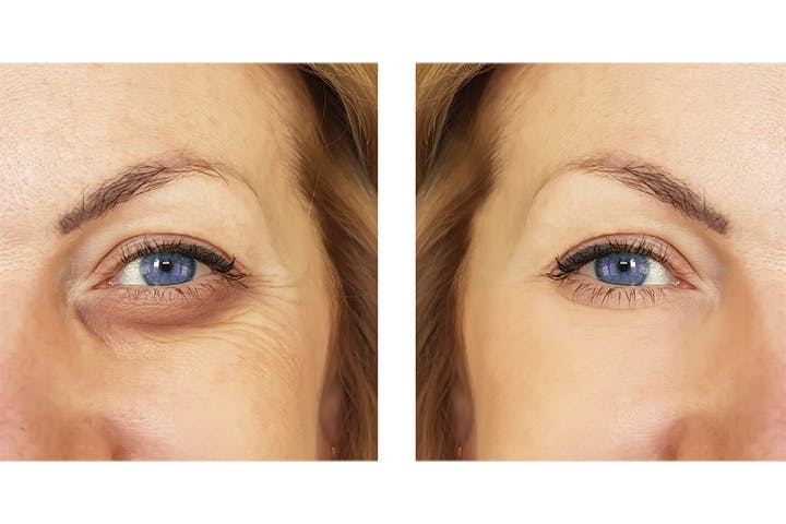 Byrdie: Everything You’ve Ever Wanted to Know About Under-Eye Filler article media