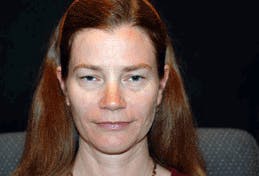 Eyelid Surgery Patient 71702036 Before & Afters