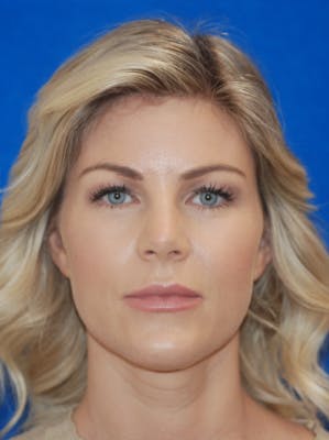 Eyelid Surgery Patient 71702036 Before & Afters