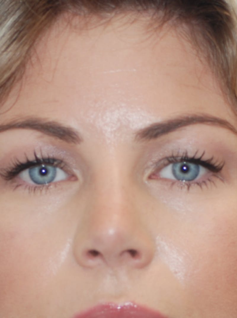 Eyelid Surgery Patient 71702035 Before Close Up