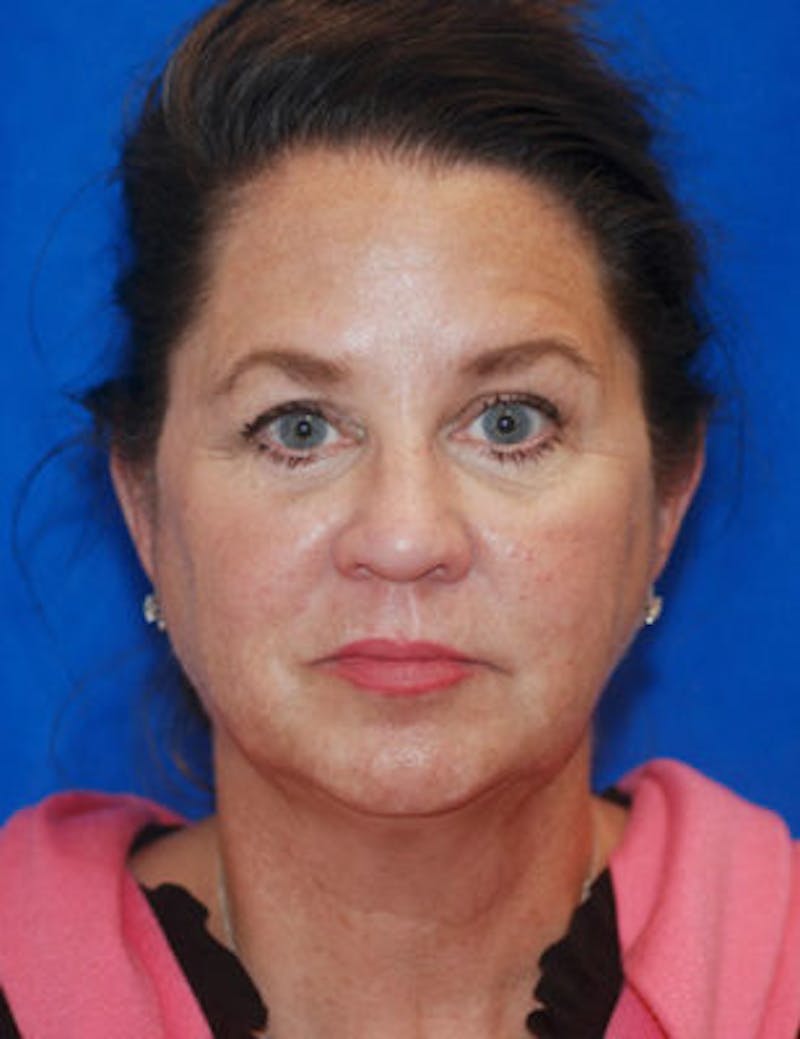 Eyelid Surgery Patient 71702036 Before Front
