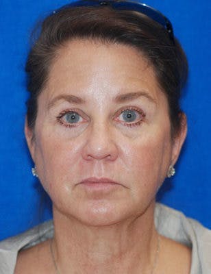 Eyelid Surgery Patient 71702036 Before & Afters