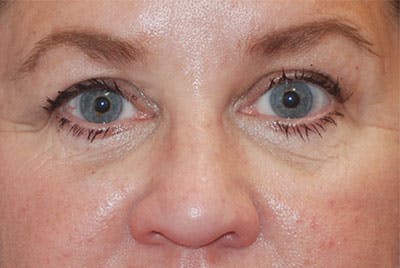 Eyelid Surgery Patient 71702036 Before & Afters