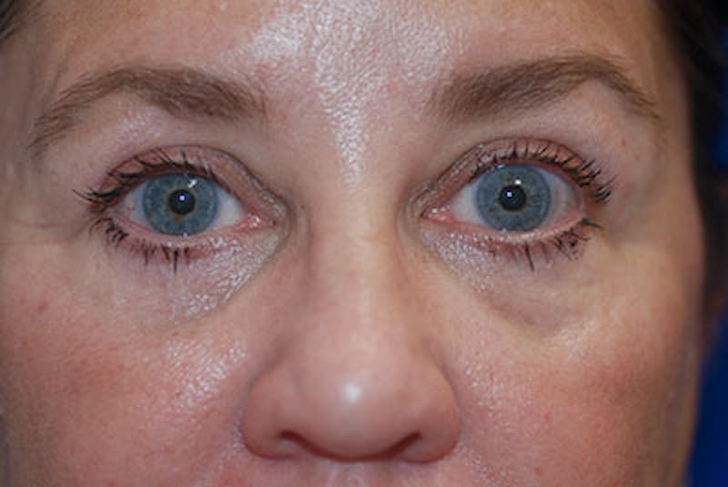 Eyelid Surgery Patient 71702036 After Close Up