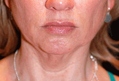 Chin Implant Before & After Gallery - Patient 175871 - Image 1