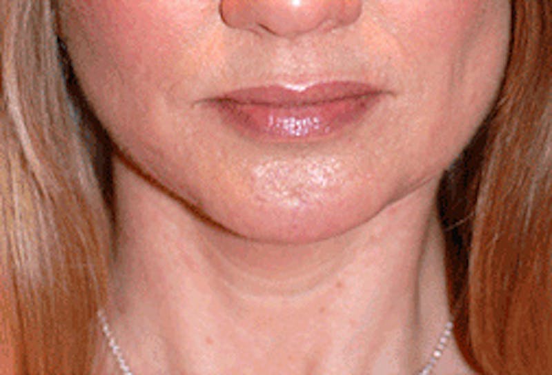 Facelift Before & After Gallery - Patient 71702220 - Image 6