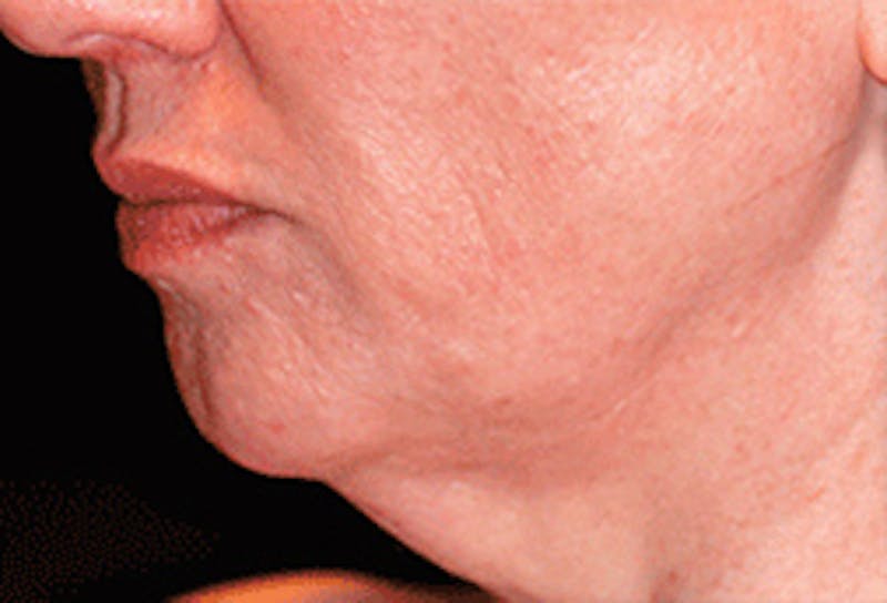 Chin Implant Before & After Gallery - Patient 175871 - Image 3
