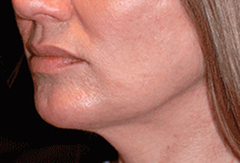 Chin Implant Before & After Gallery - Patient 175871 - Image 4