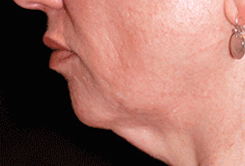 Chin Implant Before & After Gallery - Patient 175871 - Image 5
