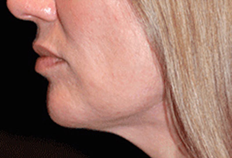 Facelift Before & After Gallery - Patient 71702220 - Image 4