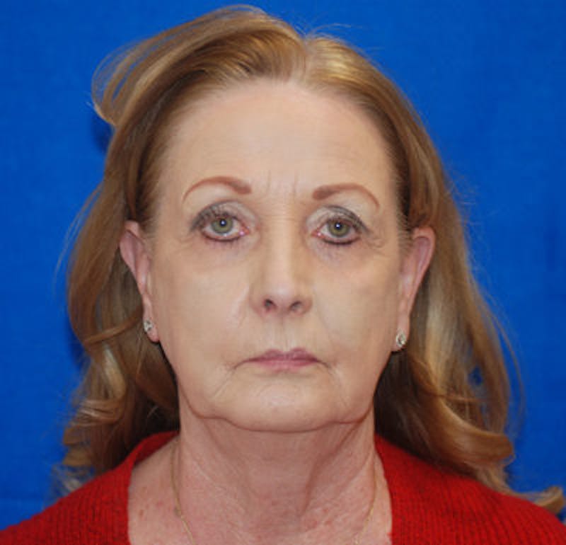 Facelift Before & After Gallery - Patient 71702230 - Image 5