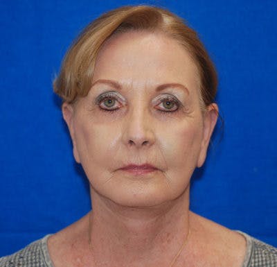 Facelift Before & After Gallery - Patient 71702230 - Image 2