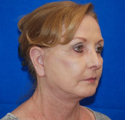 Facelift Before & After Gallery - Patient 71702230 - Image 2