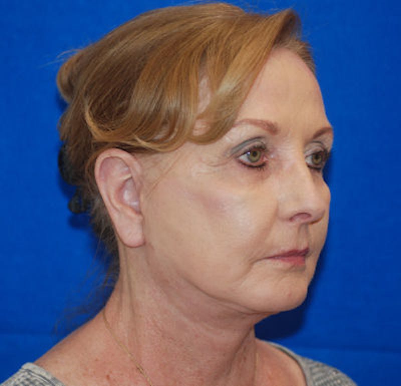 Facelift Before & After Gallery - Patient 71702230 - Image 4