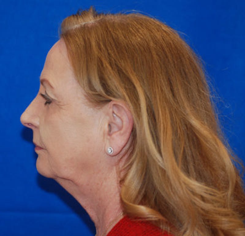 Facelift Before & After Gallery - Patient 71702230 - Image 3