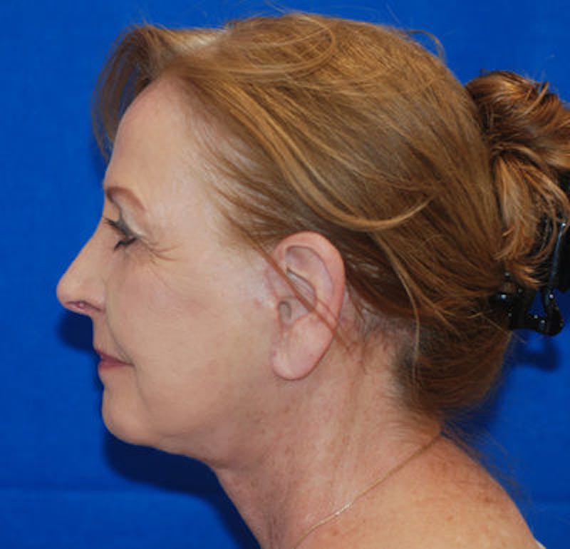Facelift Before & After Gallery - Patient 71702230 - Image 4