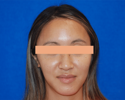 Jawline Reshaping and Masseters Reduction Gallery - Patient 71702507 - Image 2